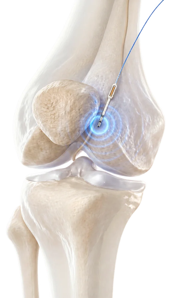 Anatomical render of a knee joint with a thin lead placed beside it, lit where it meets the nerve.
